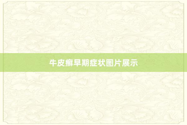 牛皮癣早期症状图片展示
